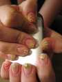 Grafting of nails