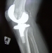 Knee Replacement